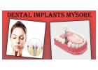 Best Dental Implants in Mysore