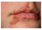 Exploring Valtrex's efficacy in treating viral herpes infection.